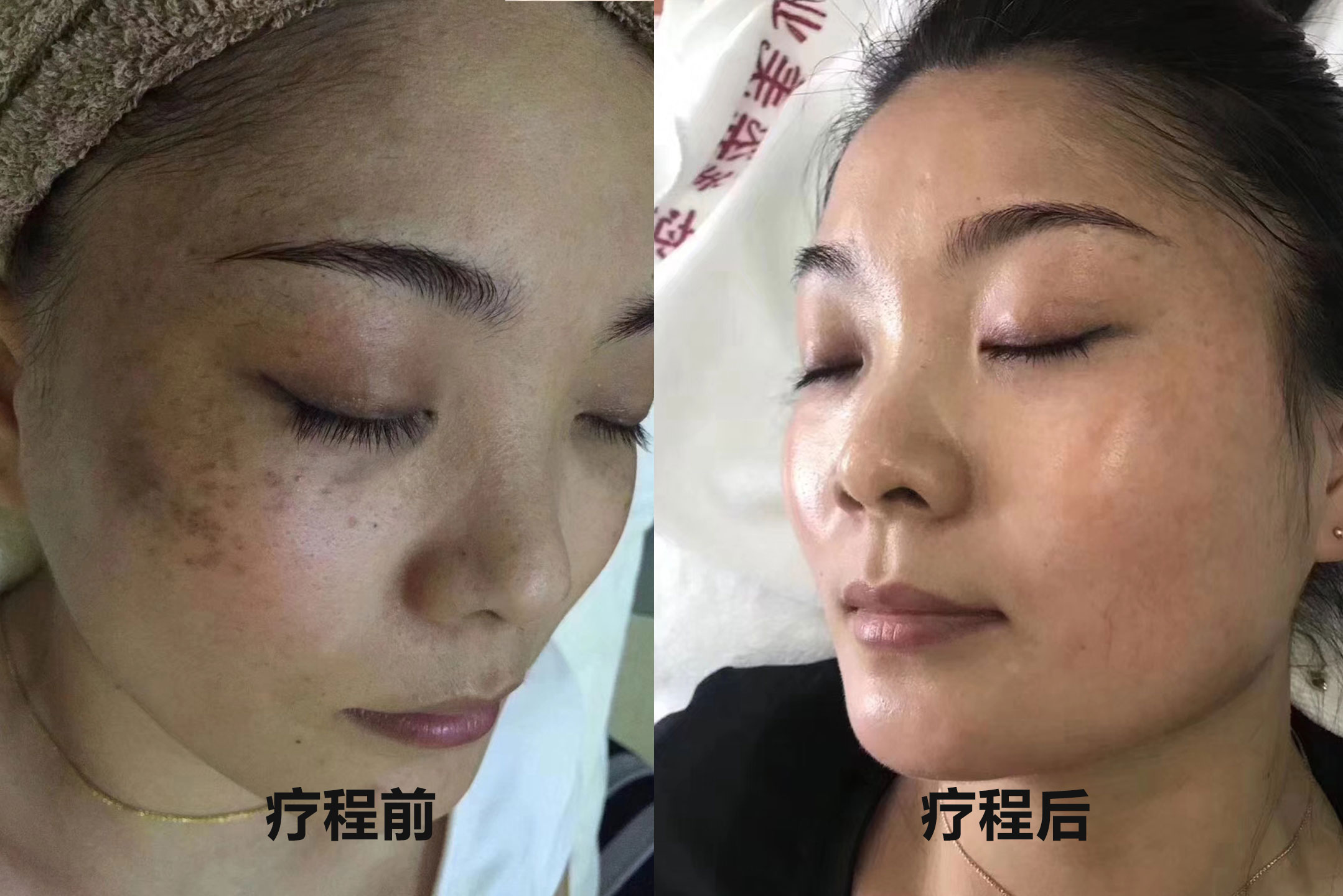 真皮斑