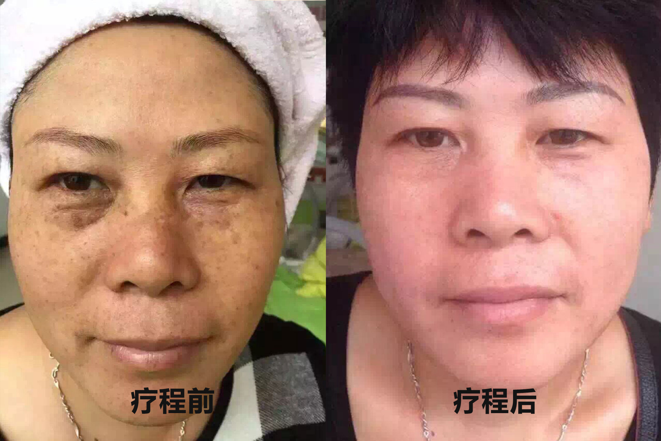 真皮斑