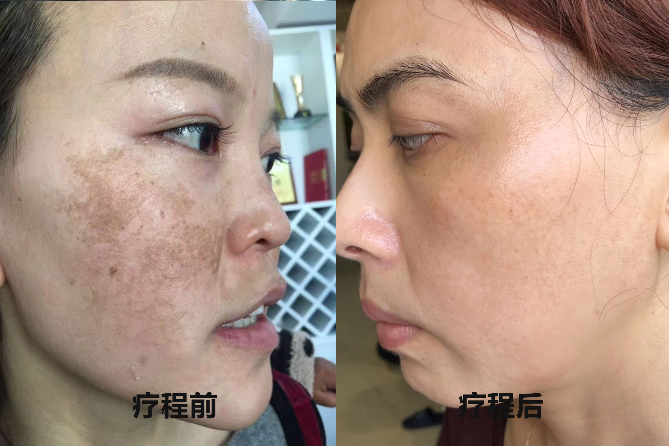 铅汞反弹斑